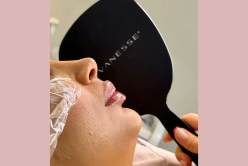 همه چیز درباره تزریق فیلر لب