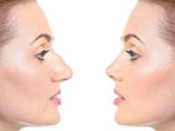 چه كسی برای جراحی بینی مناسب است؟